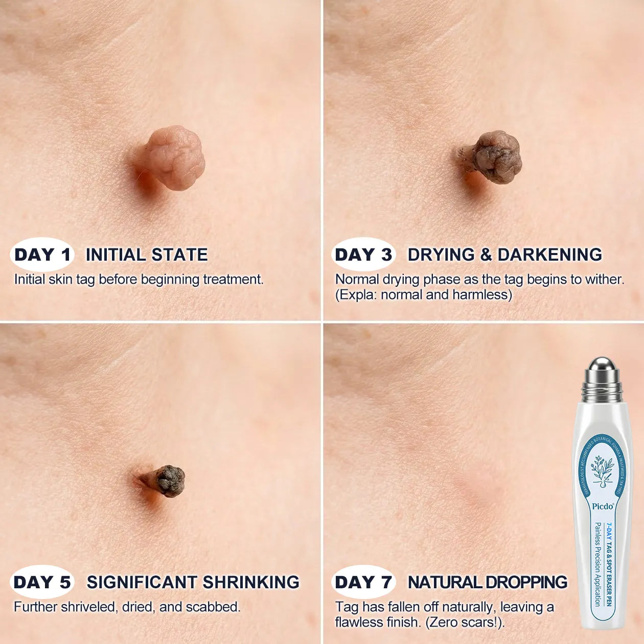 Official Brand Store |✅🧑🏻‍⚕️Natravor® 7-Day Tag & Spot Eraser(Zero Pain, Zero Scars Rollerball)