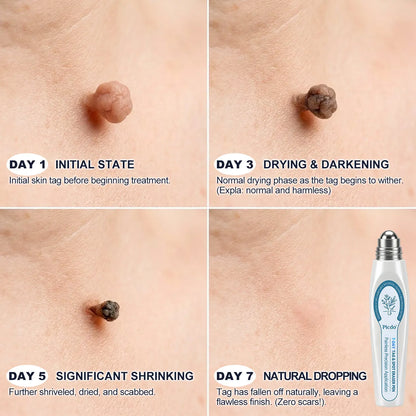 Official Brand Store |✅🧑🏻‍⚕️Natravor® 7-Day Tag & Spot Eraser(Zero Pain, Zero Scars Rollerball)